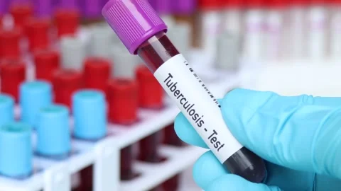 Tuberculosis test Stock Footage 239625147