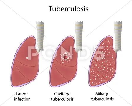 Tuberculosis types Stock Illustration