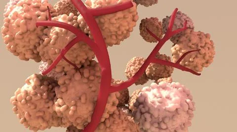 Tumor, abnormal mass of tissue that forms when cells grow and divide more than t Stock Illustration