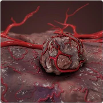 Tumor and Vessel ~ 3D Model ~ Download #91529782 | Pond5