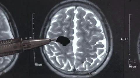 Tumor on human brain Vídeos de archivo 325664625