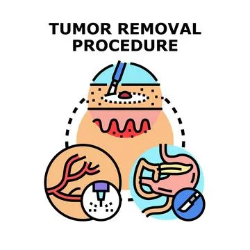 Tumor removal procedure vector concept illustration Stock Illustration
