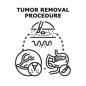 Tumor removal procedure vector concept illustration Stock Illustration