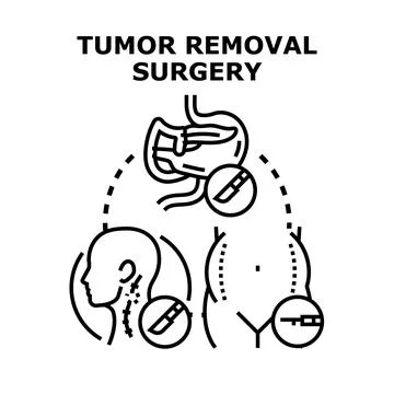 Tumor removal surgery concept presenting medical operation procedure Stock Illustration