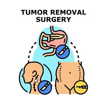 Tumor removal surgery concept presenting medical operation procedure Stock Illustration