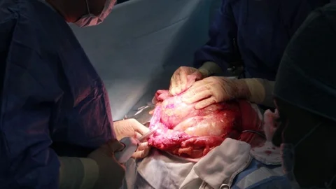 Tumor Surgery Stock Footage 128748174