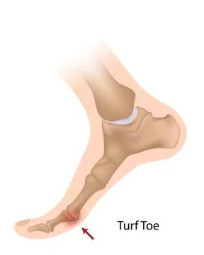 Turf toe Stock Illustration