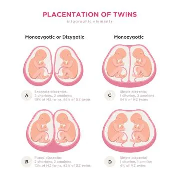 Twin types infographic elements in flat design. Monozygotic or Dizygotic Illustrazione stock