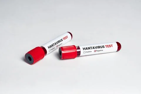Two blood sample tubes labeled Hantavirus showing positive test results on .. Stock Photos