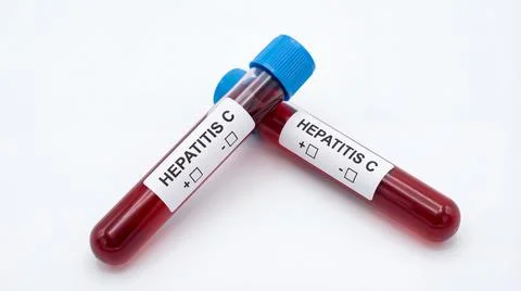 Two blood test tubes for hepatitis c diagnosis showing potential positive o.. Illustrazione stock