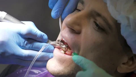 Two doctors in gloves install a dental implant.Restoration of missing teeth with Stock Footage 167448879