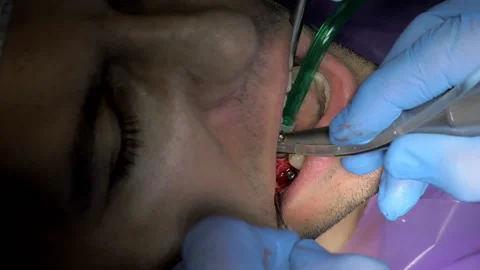 Two doctors in gloves install a dental implant.Restoration of missing teeth with Stock Footage 167448957