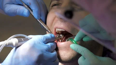 Two doctors in gloves install a dental implant.Restoration of missing teeth with Stock Footage 167448974