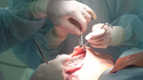 Two doctors perform an operation on an open wound on the patient's face 스톡 동영상 123569434