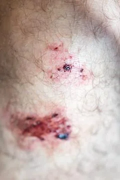 Two fresh graze wounds on a bare knee with torn skin, dried blood and darkened Stock Photos