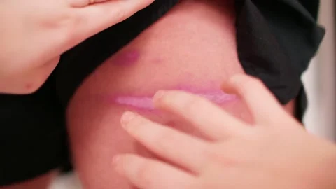 Two hands remove black shorts and demonstrate burn on white skin on leg. Hands Stock-Footage 148628120