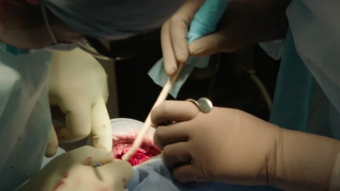 Two professional doctors perform dental surgery Stock Footage 236052886