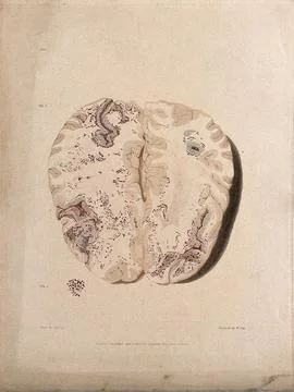 Two sections of diseased brain. Colour stipple etching by W. Say after F. R.. Stock Illustration