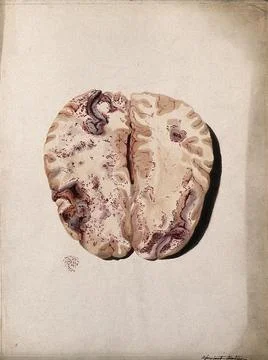 Two sections of diseased brain. Coloured stipple etching by W. Say after F... Stock Illustration