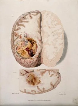 Two sections of diseased brain. Coloured stipple etching by W. Say after F... Stock Illustration