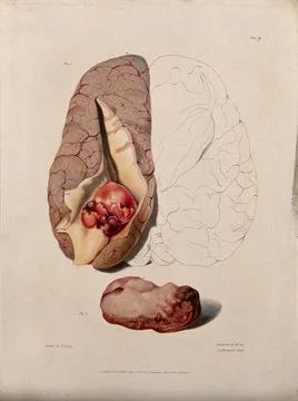 Two sections of diseased brain. Coloured stipple etching by W. Say after F... Stock Illustration