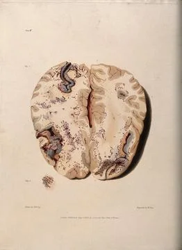 Two sections of diseased brain. Coloured stipple etching by W. Say after F... Stock Illustration