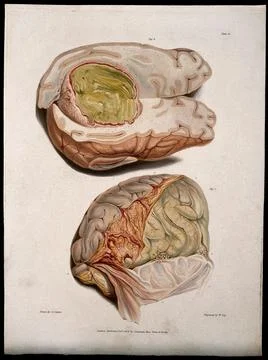 Two sections of diseased brain. Coloured stipple etching by W. Say after C... Stock Illustration