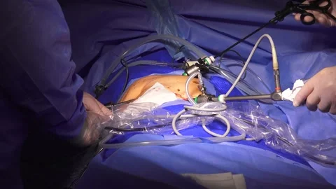 Two surgeons performing a Laparoscopic Surgery in the hospital Stock Footage 239580038