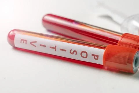 Two test tubes with a blood test and the inscription positive Stock-Fotos