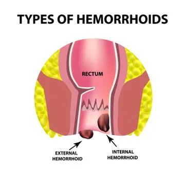 Two types of hemorrhoids are external and internal. Rectum structure. Intestines Stock Illustration