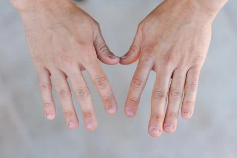 Two young man hands with ugly and bitten fingernails Stock-Fotos