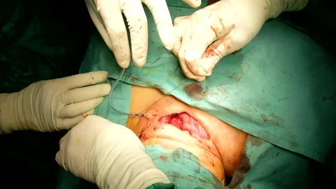 Tying  A Drain after completion of Operation Stock Footage 131789023