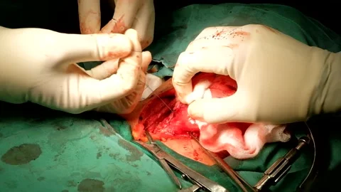 Tying Pedicle of Thyroid. Stock Footage 131789022