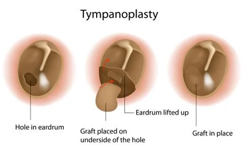Tympanoplasty procedure Stock Illustration