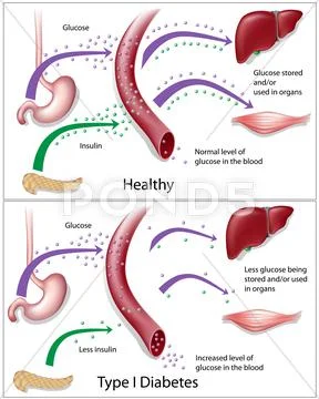 Type 1 diabetes Stock Illustration