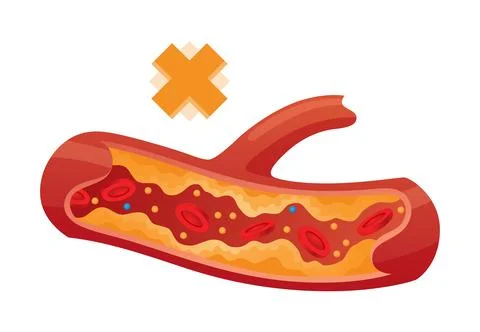 Type of cholesterol in human blood vessels. Narrowed artery for explanation Stock Illustration