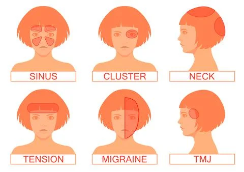 Type of headache pain Stock Illustration