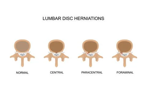 Type of lumbar disc herniations Illustrazione stock