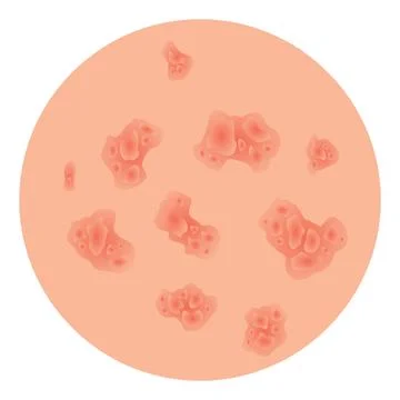 Type of psoriasis vector. Part of patients skin with dermatitis, inflammation Stock Illustration