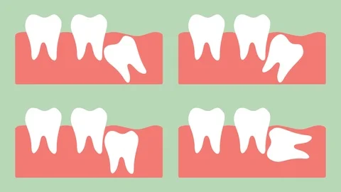 Type of wisdom tooth Stock Footage 105337931