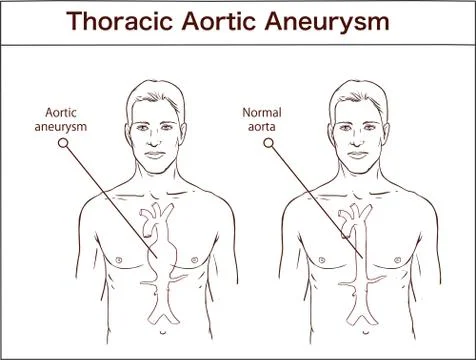 Types of abdominal aortic aneurysm. normal aorta and enlarged vessels. Vector Stock Illustration