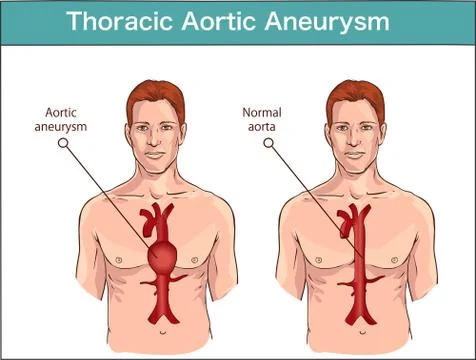 Types of abdominal aortic aneurysm. normal aorta and enlarged vessels. Vector Stock Illustration