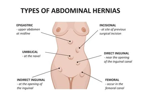 Types of abdominal hernias Stock Illustration