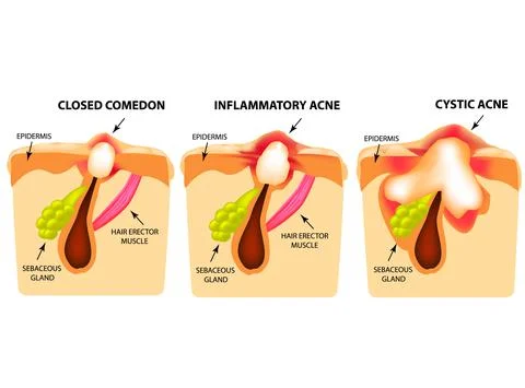 Types of acne. Closed comedones, inflammatory acne, cystic acne. The structure Stock Illustration