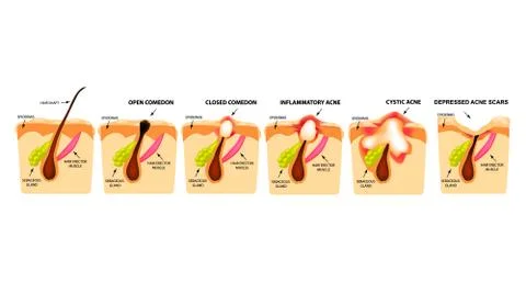 Types of acne. Closed comedones, open comedones, inflamed acne, cysts. Inflamed Stock Illustration