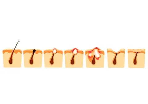 Types of acne. Closed comedones, open comedones, inflamed acne, cysts. Inflamed Stock Illustration