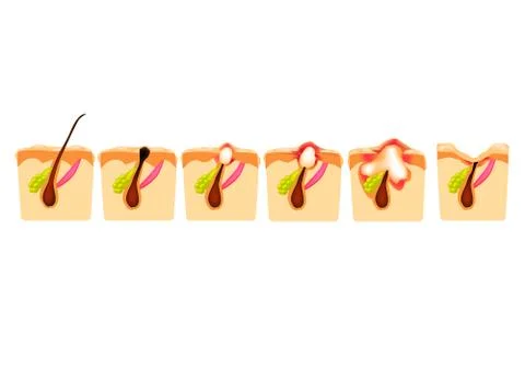 Types of acne. Closed comedones, open comedones, inflamed acne, cysts. Inflamed Stock Illustration