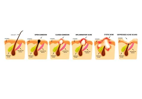 Types of acne. Closed comedones, open comedones, inflamed acne, cysts. Inflamed Stock Illustration