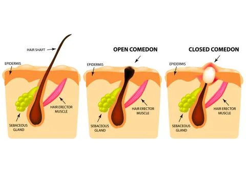 Types of acne. Open comedones, closed comedones, Skin structure. Infographics Stock Illustration