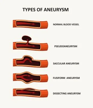 Types of aneurysm Stock Illustration